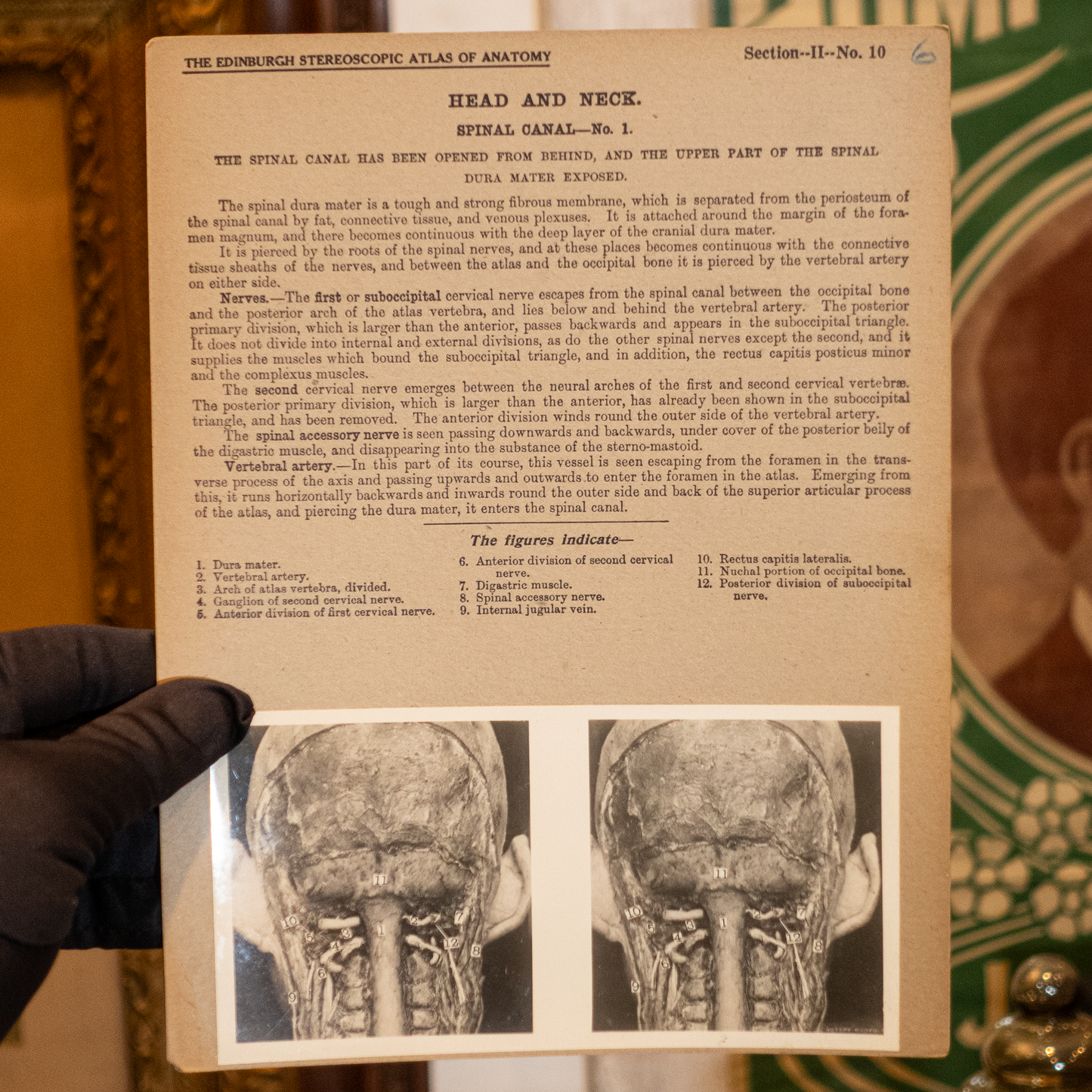 Vintage Medical Stereo View