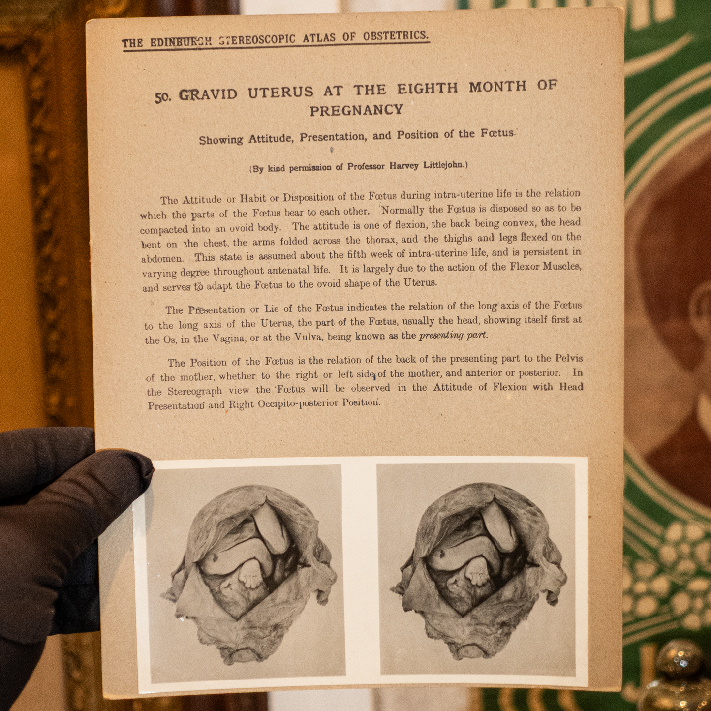 Vintage Medical Stereo View