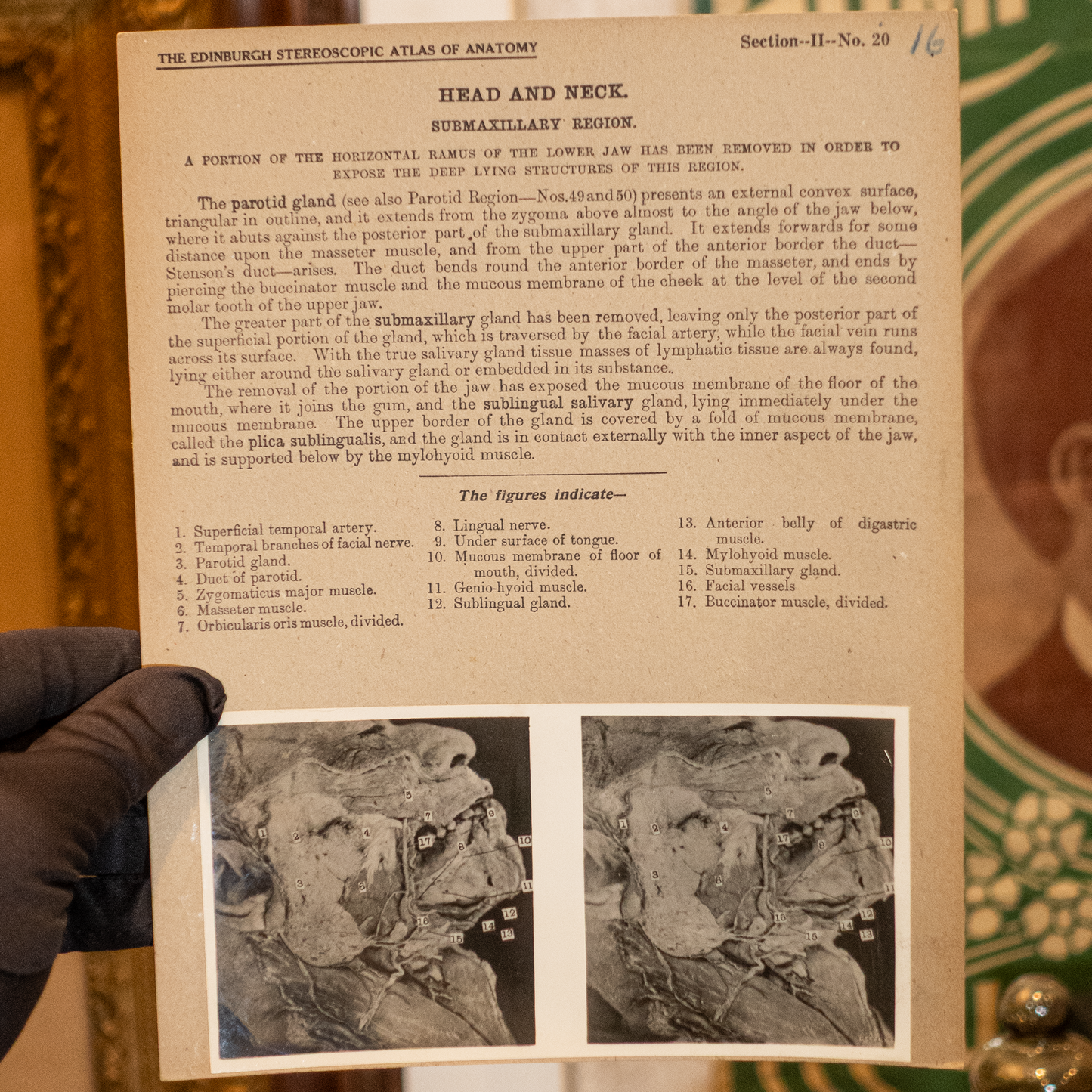 Vintage Medical Stereo View