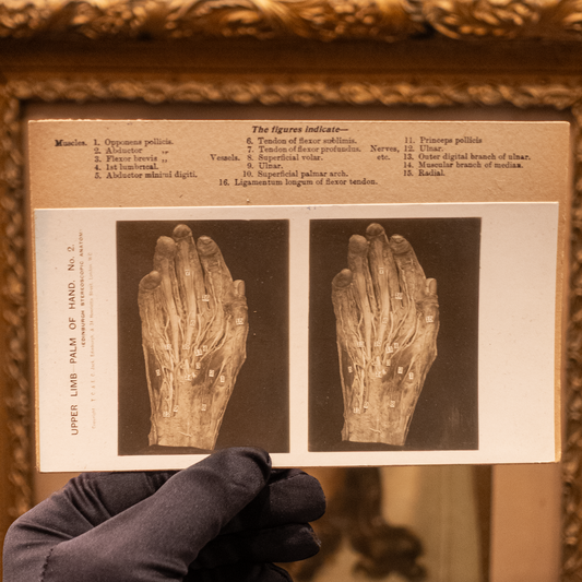 Antique Medical Stereoview