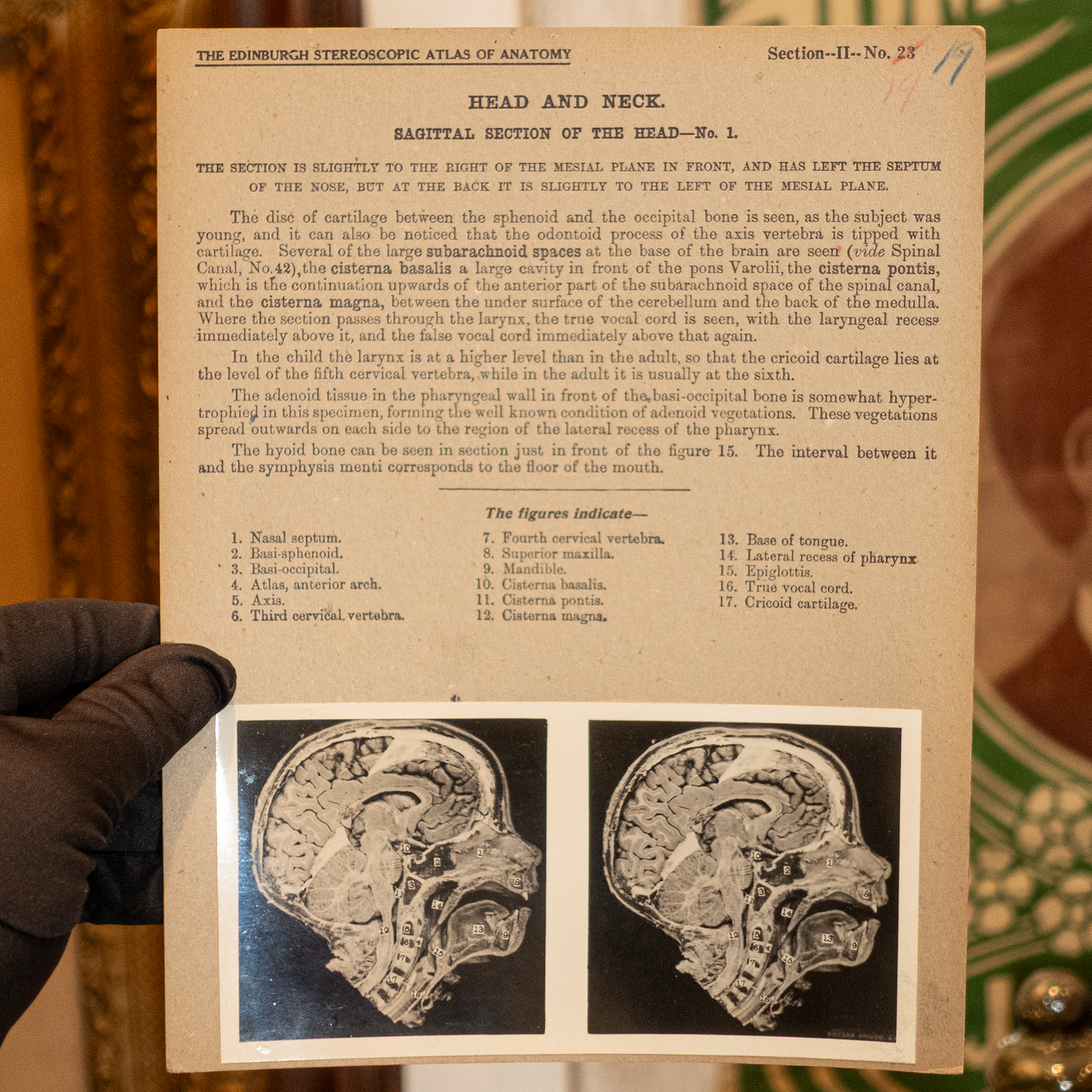 Vintage Medical Stereo View