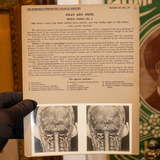 Vintage Medical Stereo View